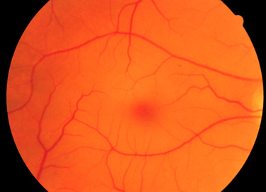 Cherry red spot in the fovea centralis of the eye