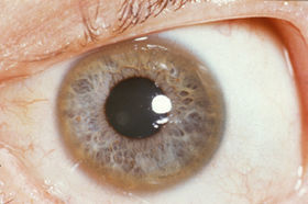 Kayser-Fleischer ring in the eye