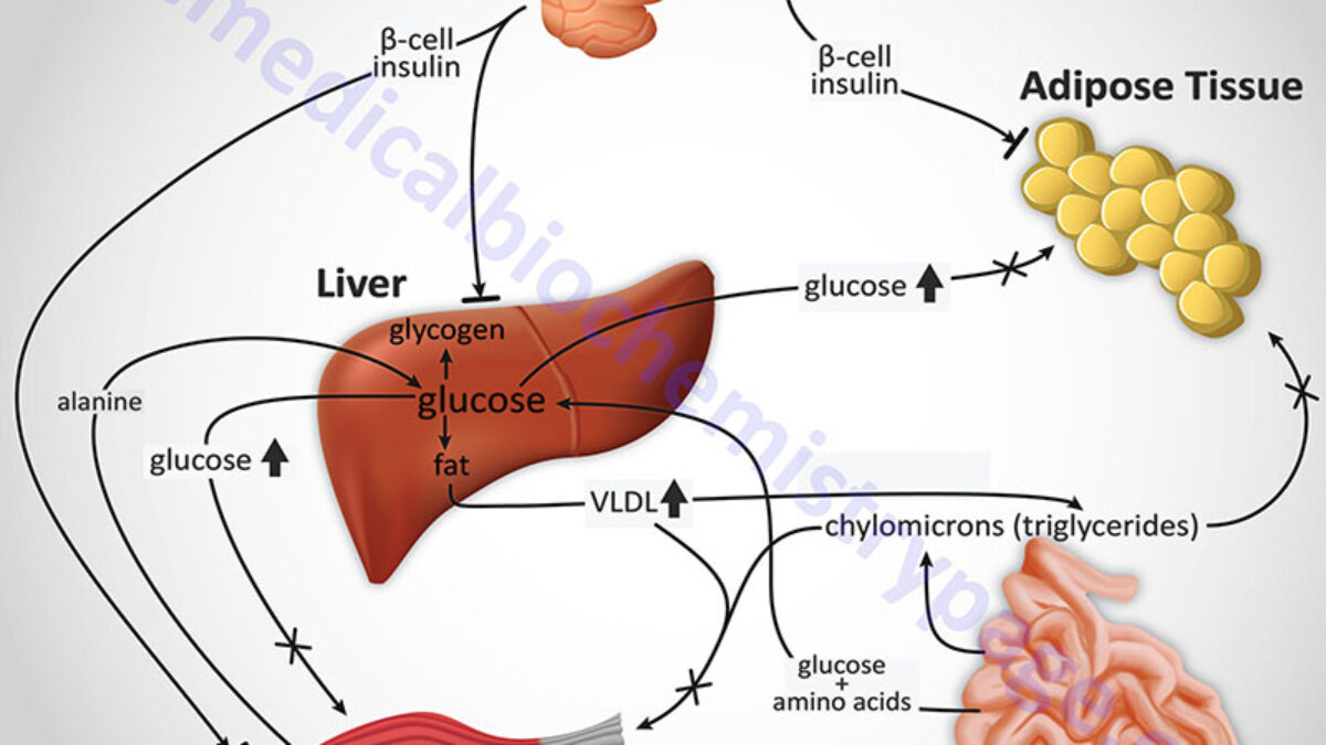 Diabetes Type 200 and Type 20   The Medical Biochemistry Page