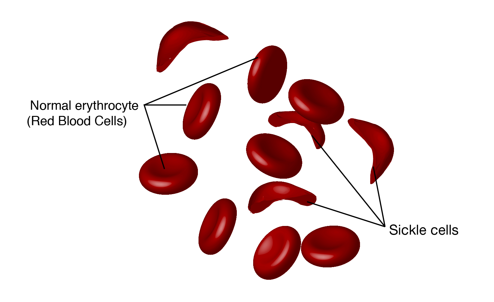 primary research article on sickle cell anemia