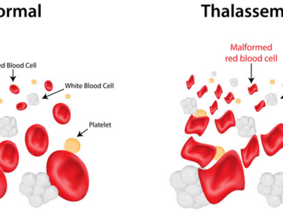 Alpha-thalassemia: Video, Anatomy & Definition