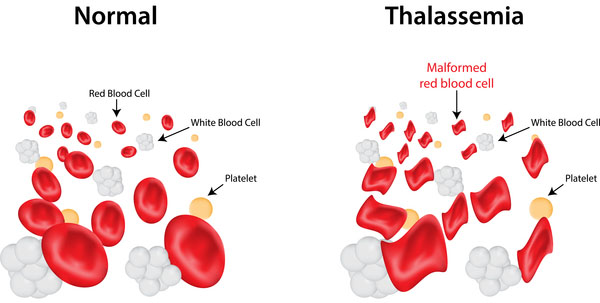 Thalassemias: α-Thalassemias